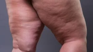 Pernas com lipedema