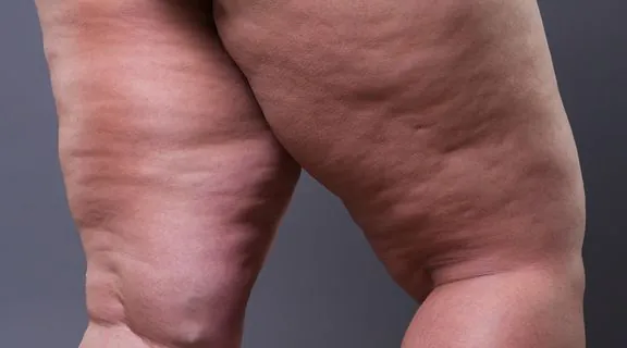 Pernas com lipedema